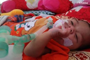 Cerita Bayi Kembar Sembuh dari Penyakit Jantung Bocor