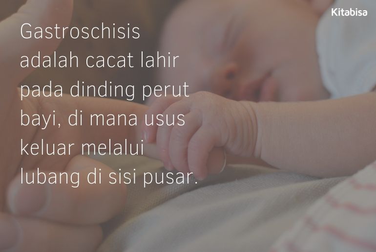 Cerita Kelainan Gastroschisis yang Diderita Bayi Sejak Lahir